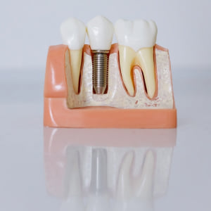 Dental Crown/Cap